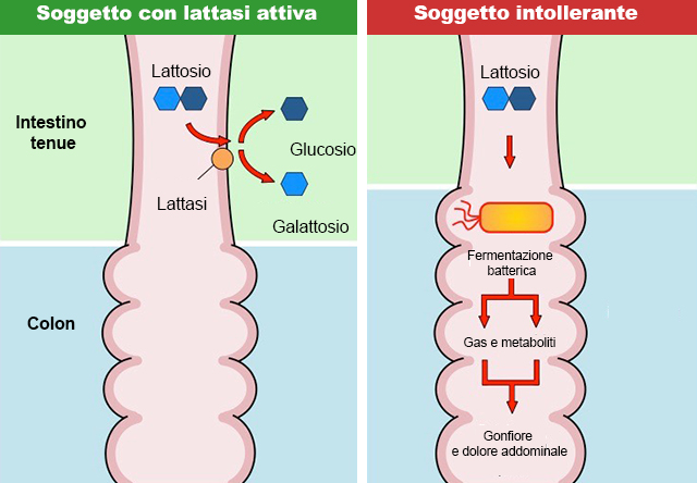 Intollerranza al lattosio, ipolattasia, deficit di lattasi, genetica e sintomi, alimenti ricchi di lattosio, dieta per il trattamento dei sintomi dell'intolleranza